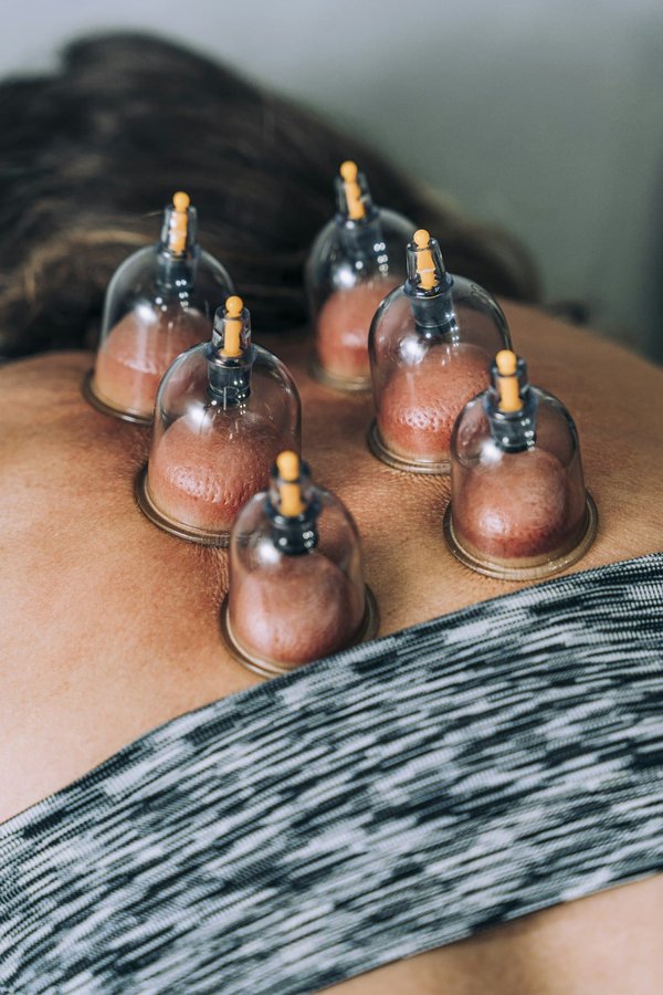 Ventouse médicale : récupération musculaire pour athlètes